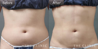 腹部(女性/36歳)4Dリポの症例画像