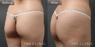 臀部(女性/29歳)4Dリポの症例画像