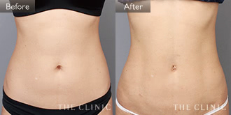 腹部(女性/32歳)4Dリポの症例画像