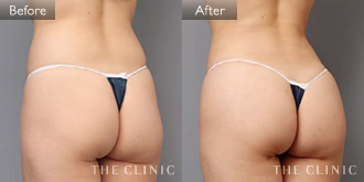 腹部〜臀部(女性/28歳)4Dリポの症例画像