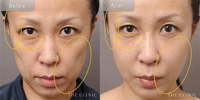 頬のコケを改善し、健康的で若々しい印象に(45歳)