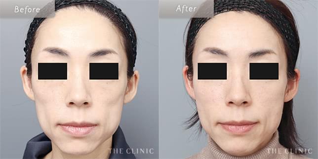 太ももの脂肪で頬のコケを改善(44歳)