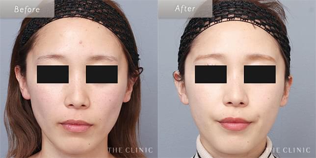 脂肪注入で頬のボリュームアップ!(26歳)