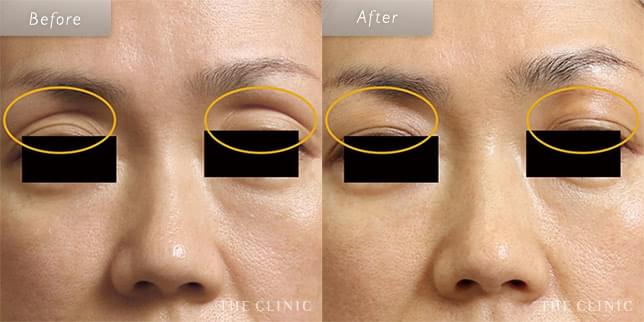 目の上の窪みがふっくら改善(45歳)