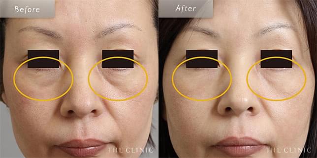 マイクロCRFで目の下のクマと肌質も改善(47歳)