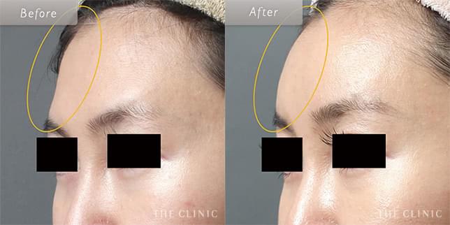 おでこの丸みを取り戻し、かわいらしい印象に(31歳)