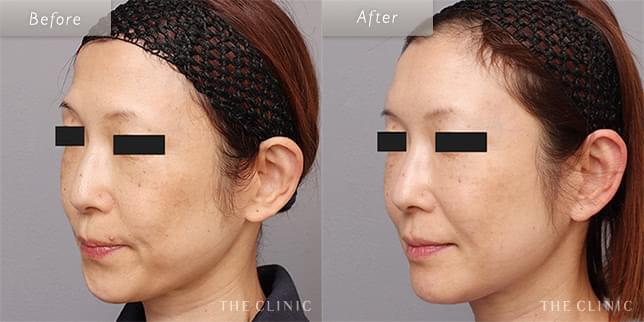 自信を持って前髪なしのヘアスタイルに(55歳)