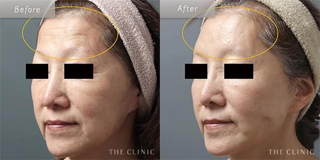 加齢による額のシワとたるみを自然に改善(59歳)