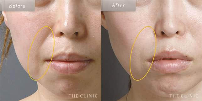 マイクロCRFでほうれい線が改善(40歳)