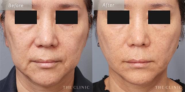 ほうれい線と顔のたるみを解消し、若返りを実現(58歳)