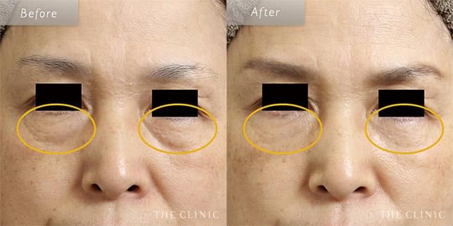 脂肪注入でゴルゴラインとクマを同時に改善(58歳)