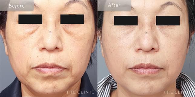 1回の脂肪注入で劇的に若返り!(53歳)