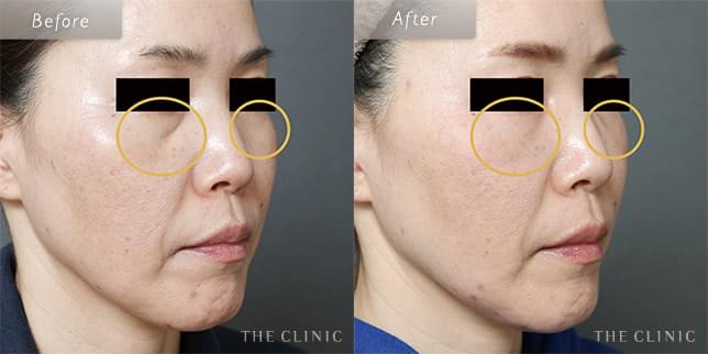 目の下のクマを解消し、若々しい目元に(48歳)