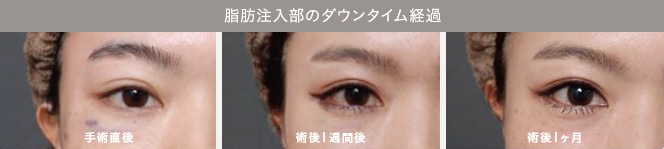 脂肪注入部のダウンタイム経過（手術直後／術後１週間後／術後１ヶ月後）