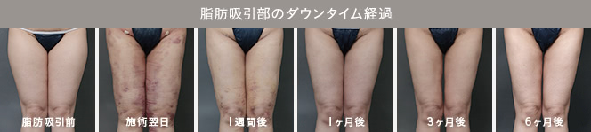 脂肪吸引部のダウンタイム経過（脂肪吸引前／施術翌日／１週間後／１ヶ月後／３ヶ月／６ヶ月後）