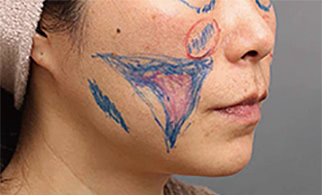 頬の脂肪を取られすぎてしまった他院修正症例の術前マーキング