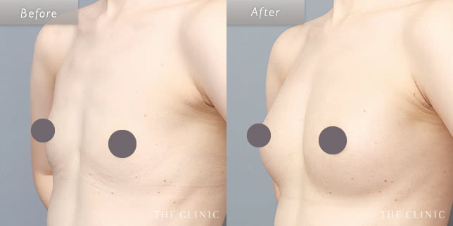 下乳もふっくらし、形良く大きいバストへ（34歳）