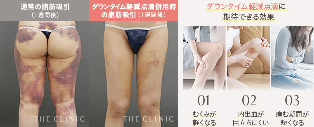 ダウンタイム軽減点滴併用時の脂肪吸引（１週間後）と通常の脂肪吸引（１週間後） / ダウンタイム軽減点滴に期待できる効果 1.むくみが軽くなる 2.内出血が目立ちにくい 3.痛む期間が短くなる