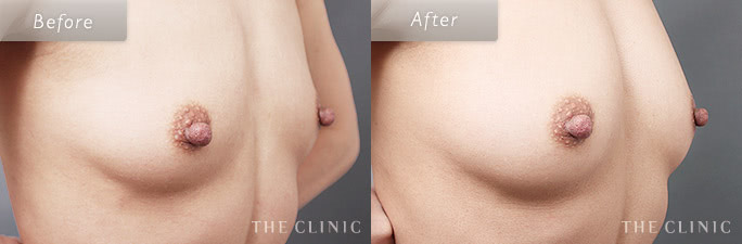 コンデンスリッチ豊胸の脂肪注入豊胸の症例画像