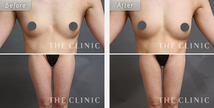 産後、授乳後のたるみにも効果的なコンデンスリッチ豊胸の症例