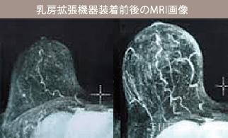 乳房拡張機器装着前後のMRI画像