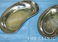 除去したヒアルロン酸