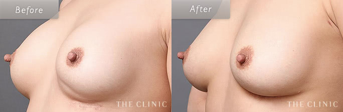 シリコンバッグ豊胸トラブルの症例画像