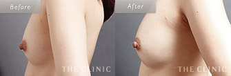 脂肪注入豊胸トラブルの症例画像