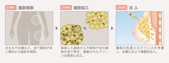 STEP１脂肪採取：太ももやお腹など、皮下脂肪が多い部位から脂肪を採取。 | STEP２脂肪加工：採取した脂肪から不純物や老化細胞を取り除き、濃縮されたクリーンな脂肪に加工。 | STEP３注入：健側の乳房とのバランスを考慮し、必要に応じて複数回注入。