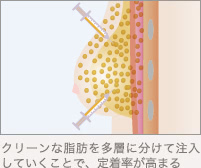 クリーンな脂肪を多層に分けて注入していくことで、定着率が高まる