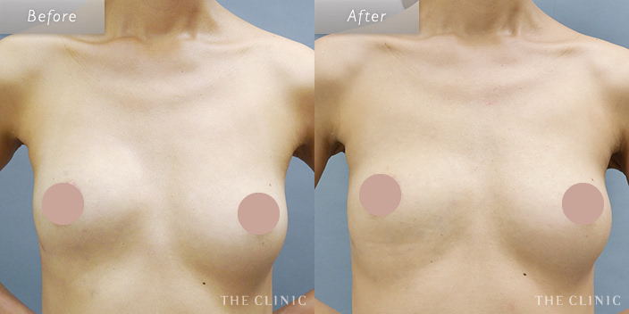 脂肪注入による乳房再建のビフォーアフター画像2