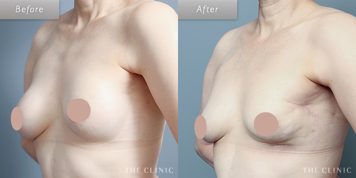 脂肪注入による乳房再建のビフォーアフター画像3