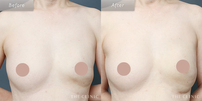 脂肪注入による乳房再建のビフォーアフター画像4