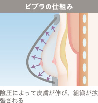 ビブラ仕組み：陰圧によって皮膚が伸び、組織が拡張される