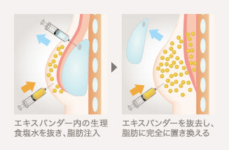 エキスパンダー除去+脂肪注入：エキスパンダー内の生理食塩水を抜き、脂肪注入→エキスパンダーを抜去し、脂肪に完全に置き換える