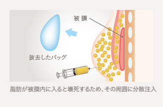 インプラント除去+脂肪注入:脂肪が被膜内に入ると壊死するため、その周囲に分散注入