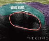瘢 痕