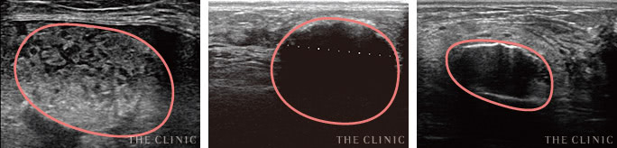 しこりができる原因