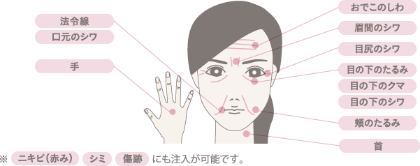 <?php echo $sub_name; ?>の適応部位