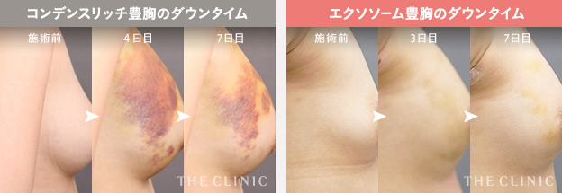 コンデンスリッチ豊胸のダウンタイム / エクソソーム豊胸のダウンタイム