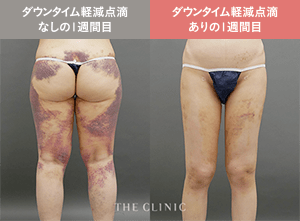 ダウンタイム軽減点滴