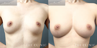 女性/29歳のコンデンスリッチ豊胸の症例画像