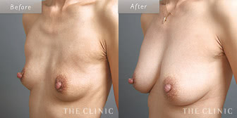 女性/47歳のコンデンスリッチ豊胸の症例画像