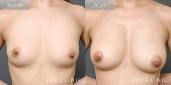 女性/28歳のコンデンスリッチ豊胸の症例画像