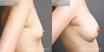 女性/28歳のコンデンスリッチ豊胸の症例画像