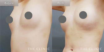 女性/20代のコンデンスリッチ豊胸の症例画像