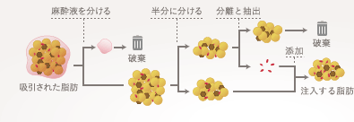 SVF（非培養幹細胞）注入