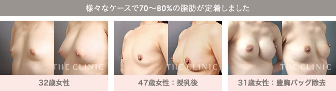様々なケースで70〜80%の脂肪が定着しました | 32歳女性 / 47歳女性：授乳後 / 31歳女性：豊胸バッグ除去