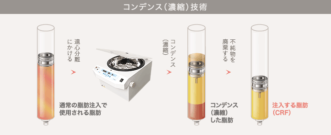 コンデンス(濃縮)技術: 通常の脂肪注入で使用される脂肪 / 遠心分離にかける / コンデンス(濃縮) / コンデンス(濃縮)した脂肪 / 不純物を廃棄する / 注入する脂肪(CRF)