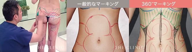 脂肪採取時に行う解剖学に基づいた360°マーキング/実際のマーキング例
